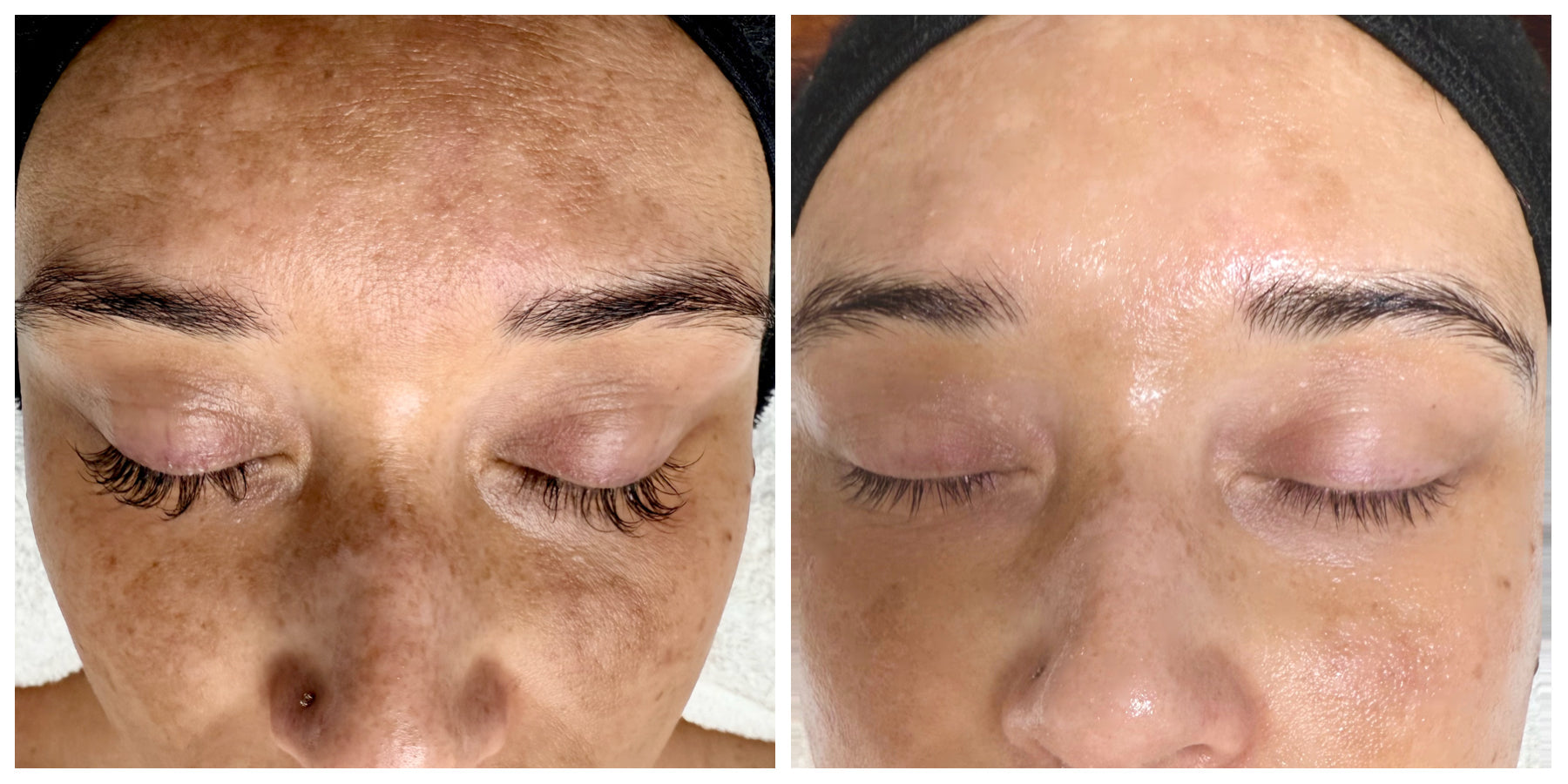 Melasma vs Sun Damage Hyperpigmentation: Causes, Differences & Gentle Treatments That Work