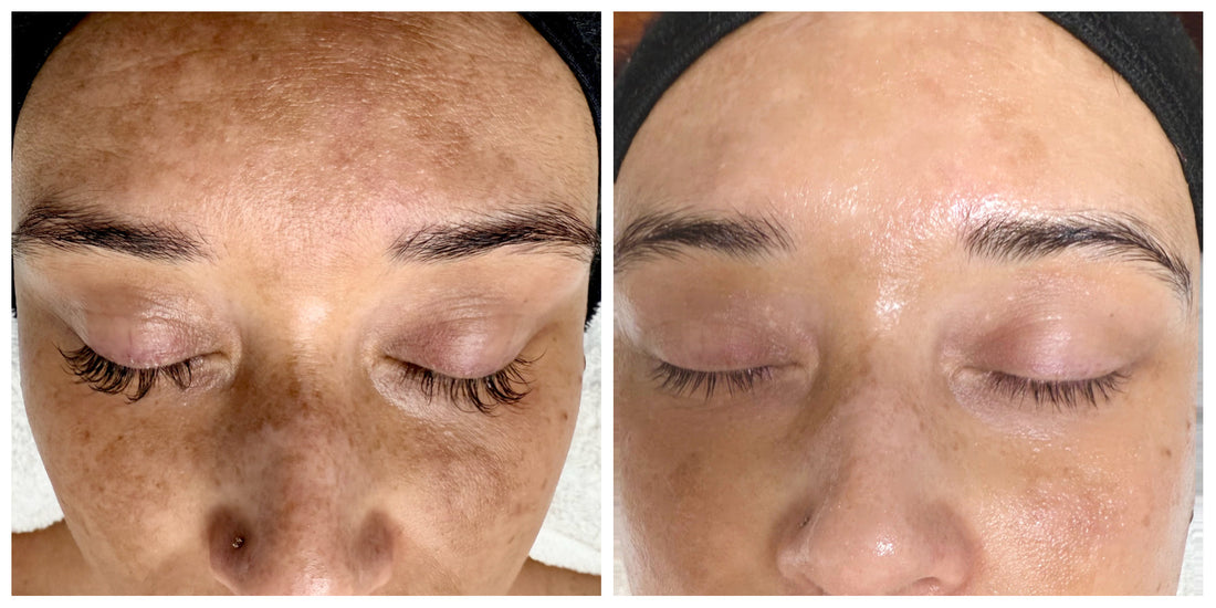 Melasma vs Sun Damage Hyperpigmentation: Causes, Differences & Gentle Treatments That Work