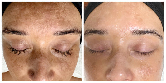 Melasma vs Sun Damage Hyperpigmentation: Causes, Differences & Gentle Treatments That Work
