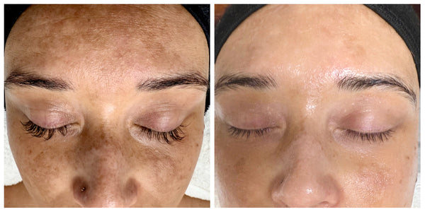 Melasma vs Sun Damage Hyperpigmentation: Causes, Differences & Gentle Treatments That Work
