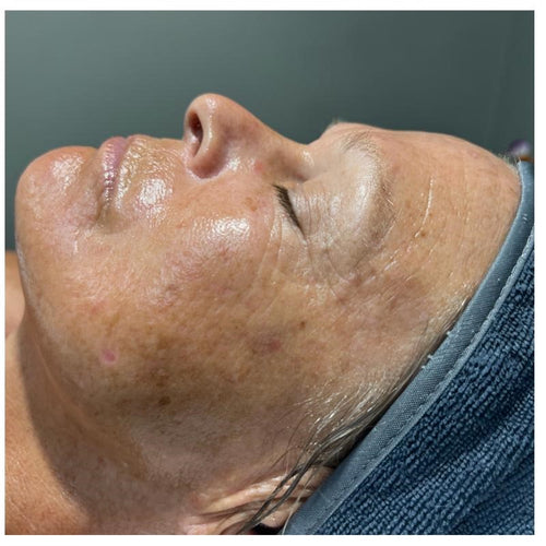 Before and after skincare result (after)