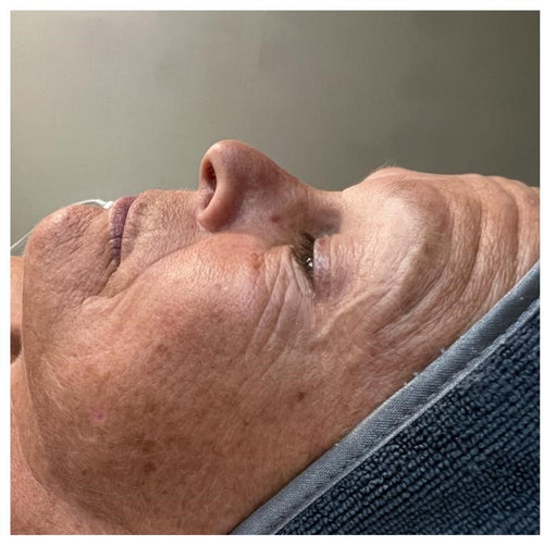 Before and after skincare result (before)