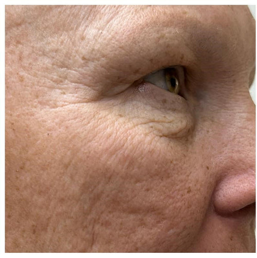 Before and after skincare result (after)