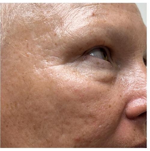 Before and after skincare result (before)