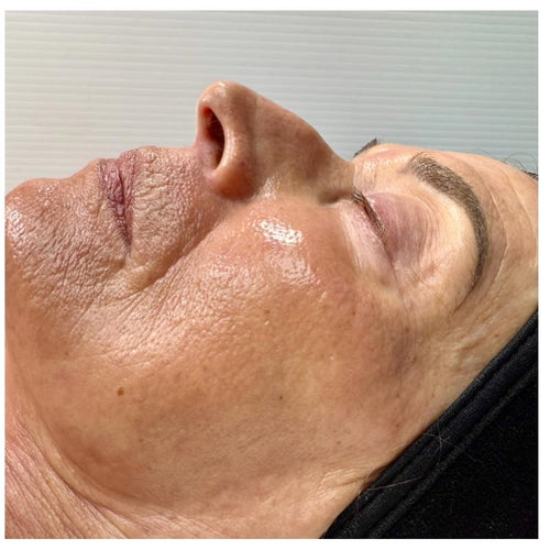 Before and after skincare result (after)