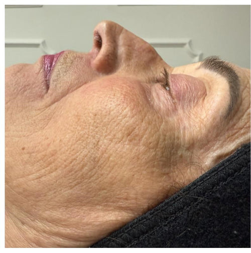 Before and after skincare result (before)