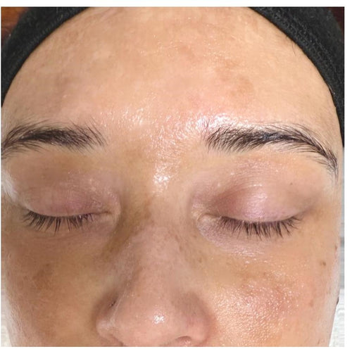 Before and after skincare result (after)