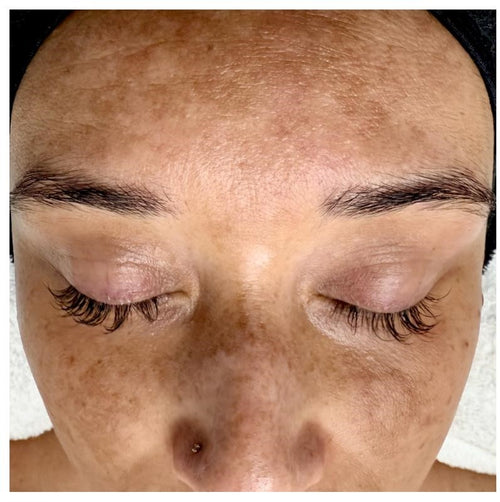 Before and after skincare result (before)