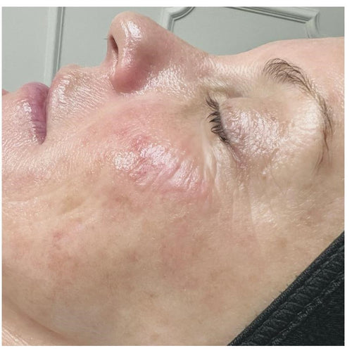 Before and after skincare result (after)