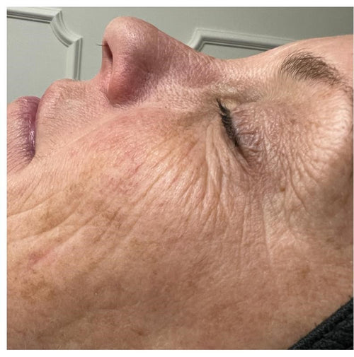 Before and after skincare result (before)