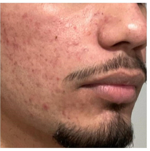 Before and after skincare result (after)
