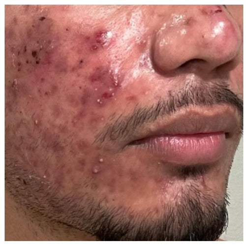 Before and after skincare result (before)