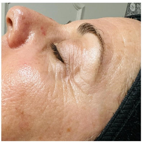 Before and after skincare result (after)