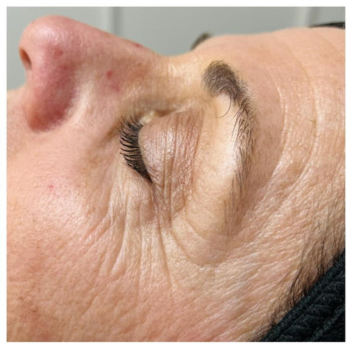Before and after skincare result (before)